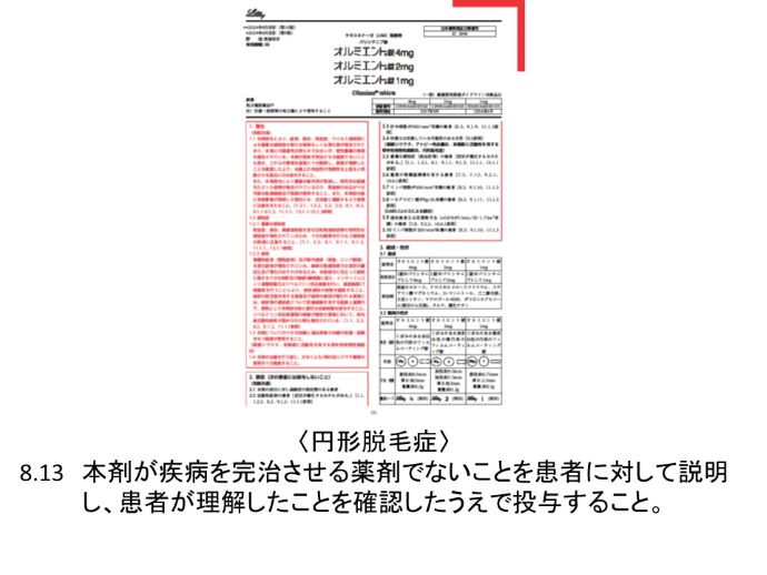 円形脱毛症　病院